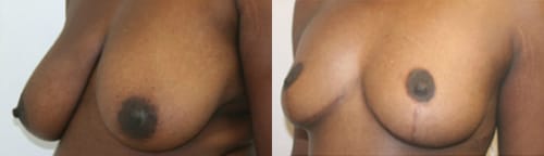 Breast Lift Before After 8b