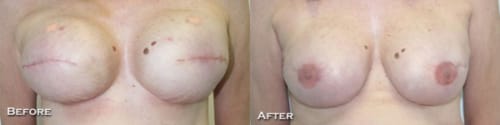 Before and After Staged Bilateral Tissue Expander/Implant Reconstruction and Nipple-Areolar Reconstruction