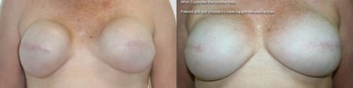 Before and After Bilateral Expander reconstruction after mastectomy and exchange to implants