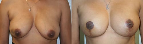 Before and After Staged UnilateralTissue Expander/Implant Reconstruction and Nipple-Areolar Reconstruction with matching procedure on opposite side
