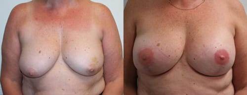 Before and After Staged Bilateral Tissue Expander/Implant Reconstruction and Nipple-Areolar Reconstruction