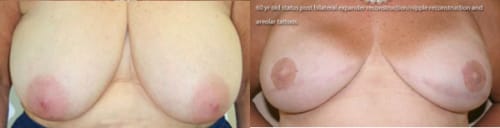 Before and After Breast Reconstruction Bilateral Staged Tissue Expander/Implant Reconstruction and Nipple-Areolar Reconstruction
