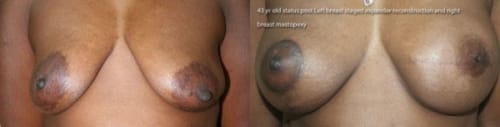 Before and After Unilateral Staged Tissue Expander/Implant Reconstruction and Nipple-Areolar Reconstruction with matching procedure on opposite side