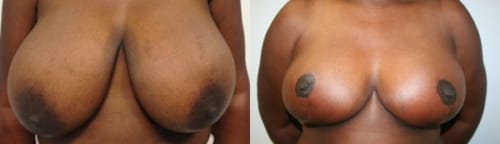 Breast Reduction Before After 1a