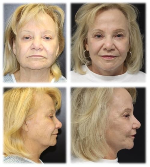 High SMAS facelift with fat grafting