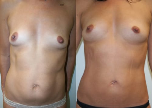 Fat Grafting to Breasts Before and After