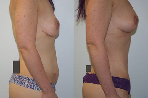 Fat Grafting to Breasts Before and After