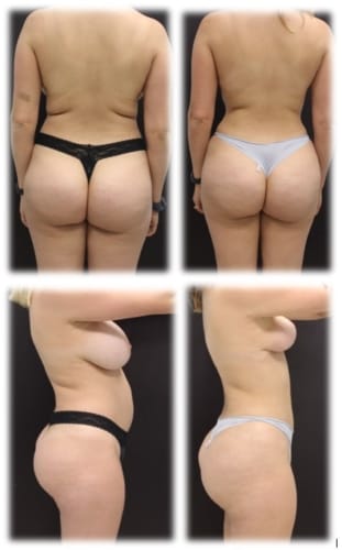 Liposuction and Lateral Thigh Fat Grafting