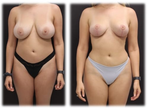 Mastopexy and Liposuction of Waist