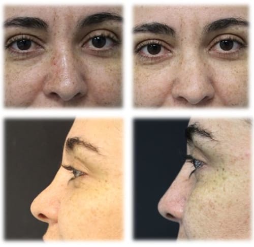 Patient with acquired nasal deformity treated with a non-operative liquid rhinoplasty