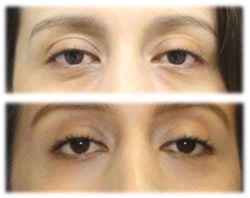 Subciliary Lower Lid Blepharoplasty and fat grafting