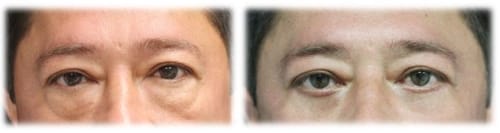 Subciliary Lower Lid Blepharoplasty