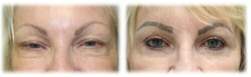 Upper Lid Blepharoplasty and Transconjunctival Lower Lid Bleph with Skin Excision