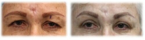 Upper Lid Blepharoplasty and Ptosis Correction with Levator Advancement