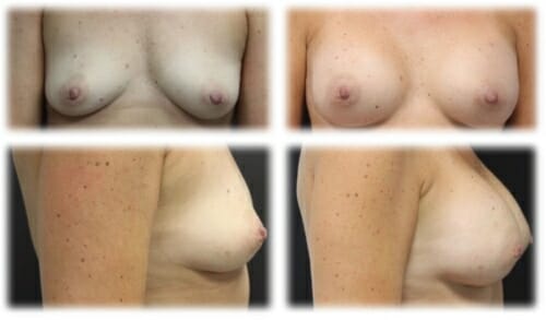 Breast Augmentation49