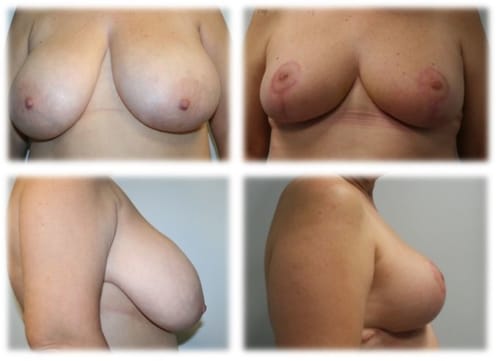 Breast Reduction17
