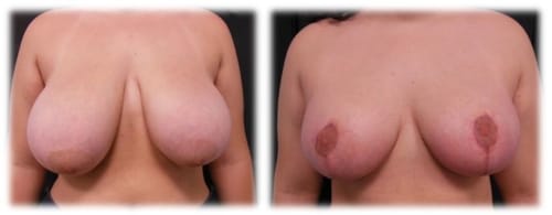 Breast Reduction21