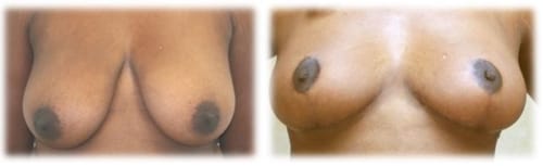 Breast Reduction23