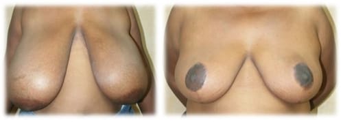 Breast Reduction31