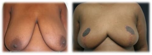 Breast Reduction34