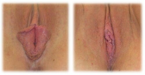Labiaplasty 2